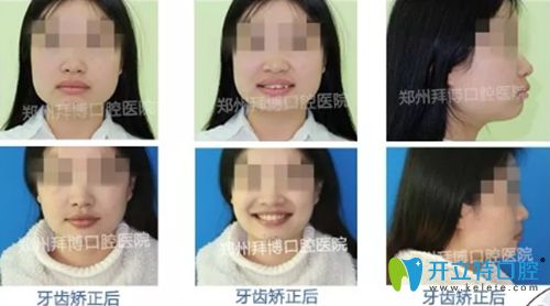 鄭州拜博口腔提供的成人牙齒矯正前后效果圖