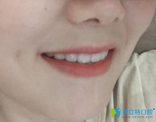 齙牙妹在鄭州拜博口腔做牙齒矯正3年效果