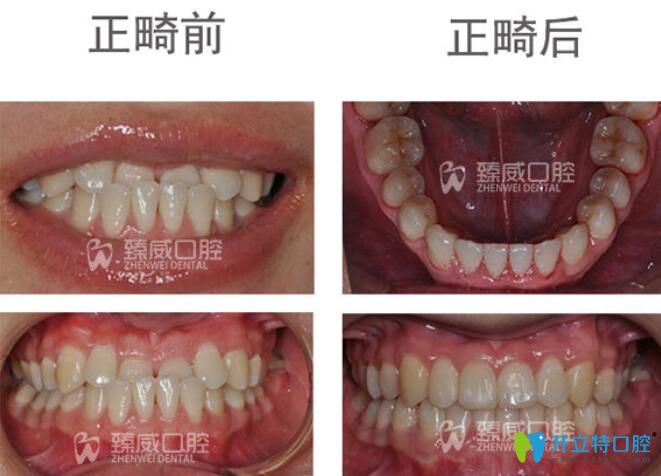 小姐姐矯正地包天后不僅牙齒變整齊了，臉型也有了很大的改變