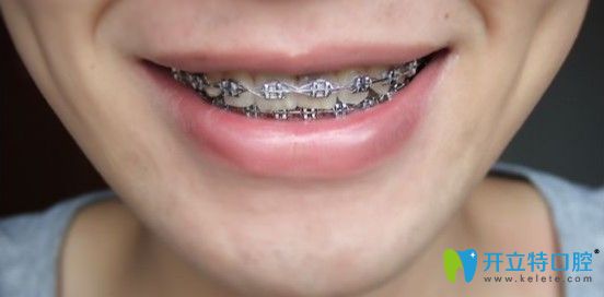 牙齒矯正一年三個(gè)月后的樣子圖