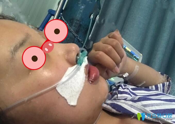廣州廣大口腔正頜手術后即刻照片
