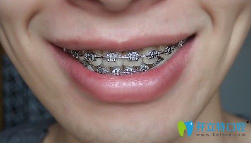 矯正5個(gè)月后的效果圖