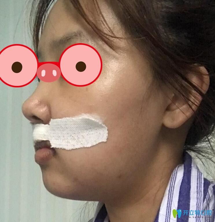 正頜手術后第3天