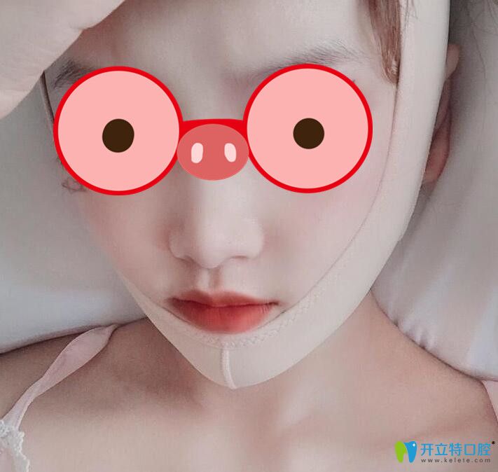 突嘴矯正第10天恢復情況