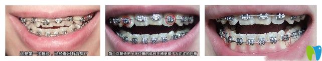 前三次復(fù)診圖示