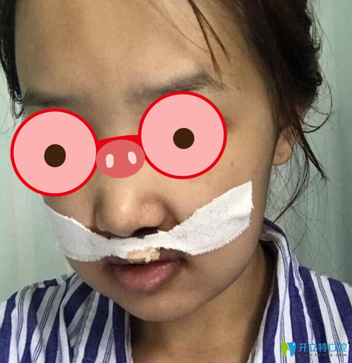 正頜手術后第2天