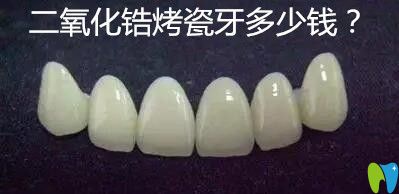 二氧化鋯烤瓷牙多少錢?價(jià)格800元一顆貴嗎?