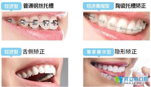 牙套類(lèi)型影響牙套佩戴時(shí)間