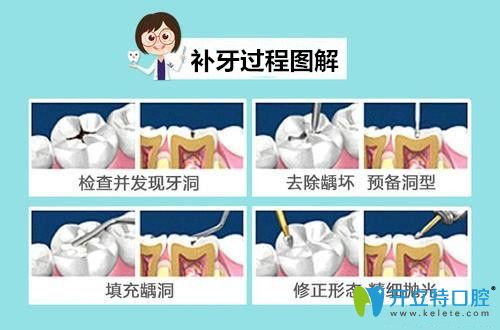 補(bǔ)牙過程圖解