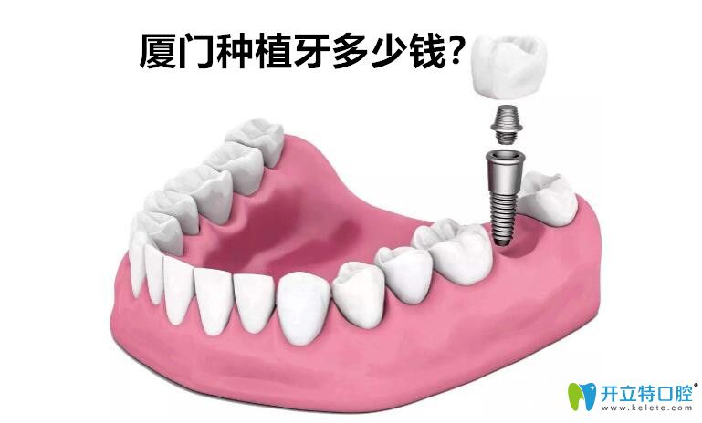 廈門種植牙多少錢？剛整理的廈門種植體品牌價格表供參考