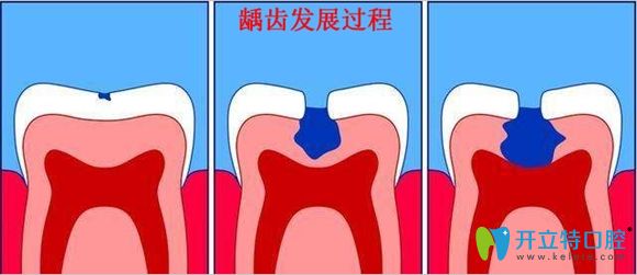 兒童齲齒一定要及時(shí)治療