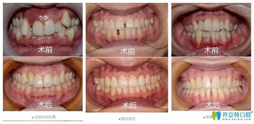 寧波恒美口腔做矯正怎么樣？矯正價格不貴技術好