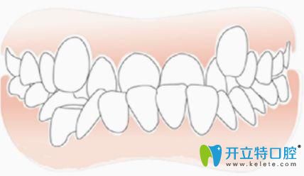 牙齒排列不齊錯(cuò)頜畸形引起顳下頜關(guān)節(jié)紊亂