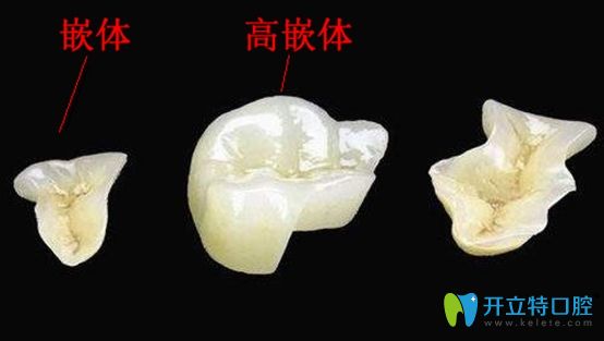 嵌體和高嵌體區(qū)別示意圖