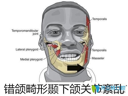 錯(cuò)頜畸形顳下頜關(guān)節(jié)紊亂矯正治療