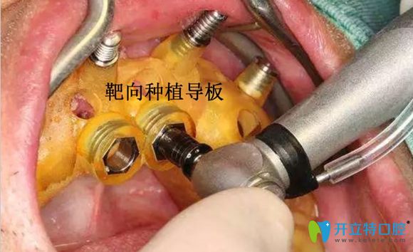 南京博韻口腔種植導板術中使用圖