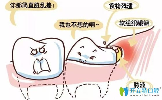 智齒長歪了會(huì)容易積聚食物殘?jiān)? border=