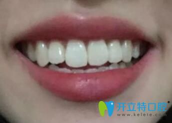 我在煙臺(tái)百仕口腔做牙齒矯正1年半