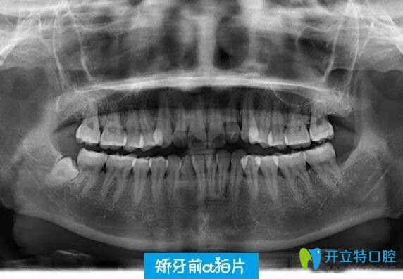 在深圳韋博口腔做牙齒矯拍CT片