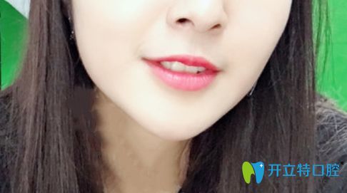 我在珠海九龍口腔做的隱形矯正價(jià)格是2萬元起