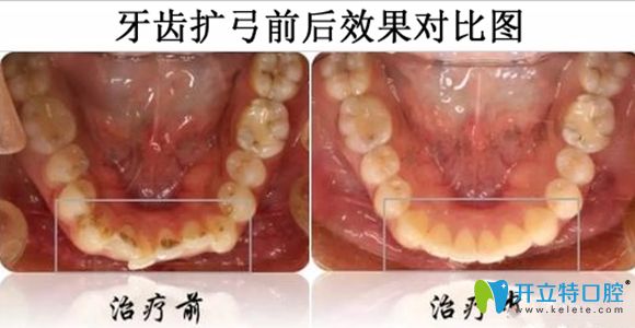 牙齒擴弓前后效果對比圖