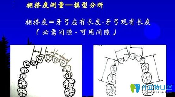 牙弓的測量示意圖