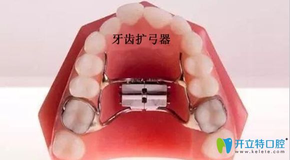 牙齒擴弓器展示圖