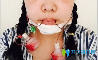 我做正頜手術(shù)的當天照