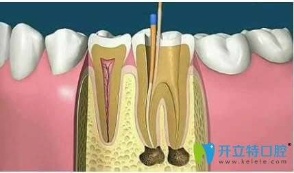 徐濤醫(yī)生科普根管治療的相關(guān)知識