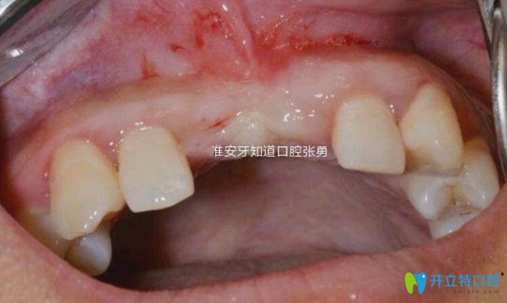 淮安哪里做種植牙好？顧客反饋淮安牙知道張勇種牙水平高