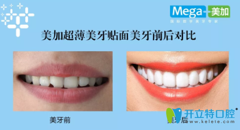 美加超薄貼面前后對比