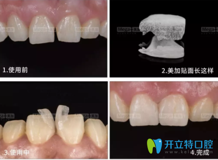 美加超薄貼面的壽命是多久？