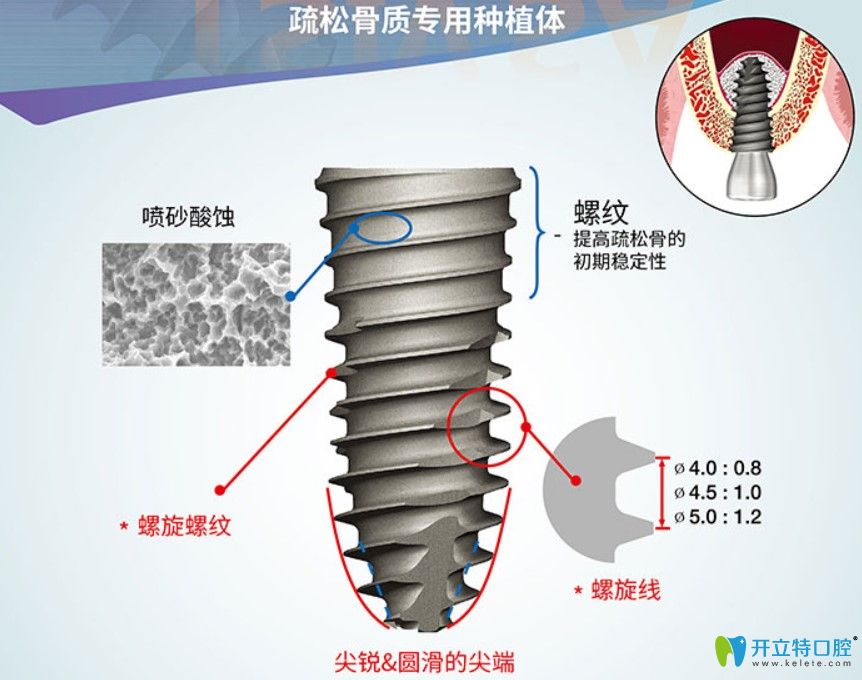 奧齒泰TSIV系列