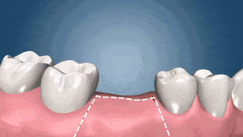 安裝愈合基臺(tái).gif