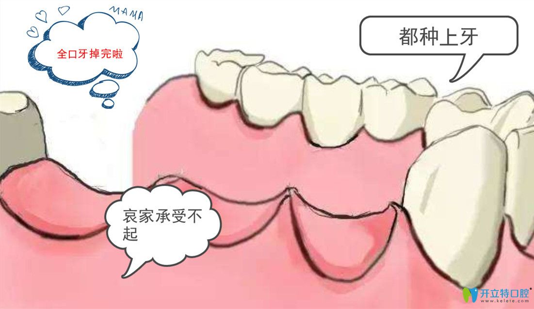 種植全口牙需要種幾顆？諾貝爾全口種植牙8顆多少錢?