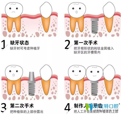 種植牙的過程是什么