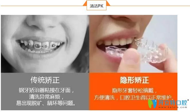 時(shí)代天使隱形矯正優(yōu)勢(shì)