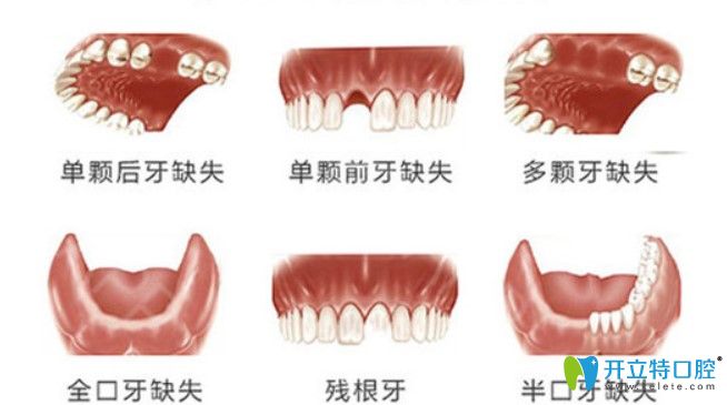只要您的牙齒出現(xiàn)圖示問題都可申請(qǐng)種植牙補(bǔ)貼