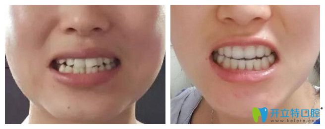 天津愛(ài)齒口腔牙齒矯正一年效果