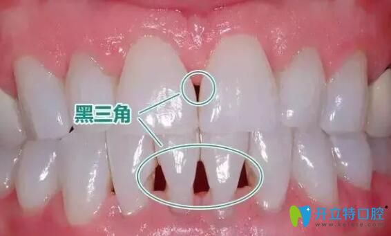 牙周炎導(dǎo)致的黑三角怎么辦？可以做貼面改善嗎
