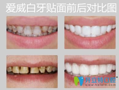 愛(ài)威白超薄牙貼面前后對(duì)比圖