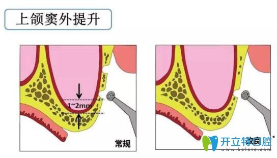 上頜竇外提升
