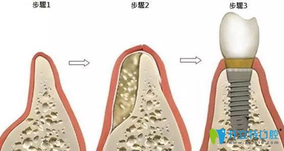 種牙植骨的步驟示意圖