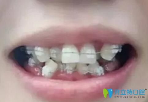 珠海牙齒矯正價(jià)格不妨看看我在九龍口腔花1萬(wàn)多矯牙后效果
