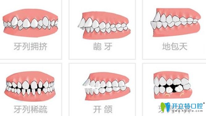 哪些牙齒問(wèn)題可以做半隱形牙齒矯正