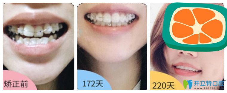 27歲牙齒不齊的小姐姐半隱形矯正前后對(duì)比圖