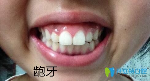 牙頜畸形之齙牙