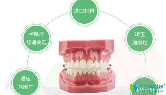 拜爾口腔牙齒矯正特色技術(shù)之半隱形矯正