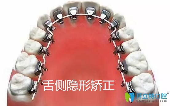 做舌側(cè)牙齒矯正會大舌頭嗎?從舌側(cè)隱形矯正的優(yōu)缺點來了解