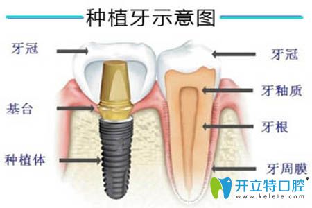 重慶美奧口腔正規(guī)可靠嗎?我做完種植牙來評價醫(yī)院收費怎樣
